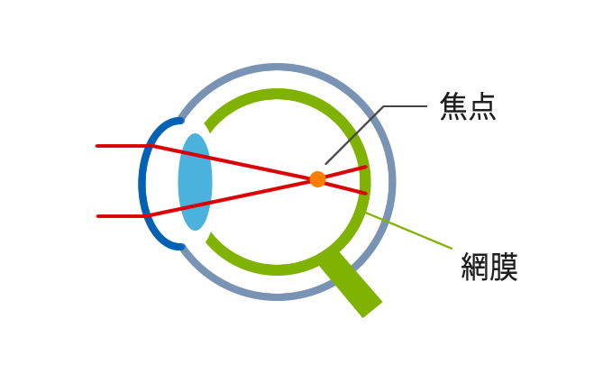 近視の見え方(屈折性近視の場合)