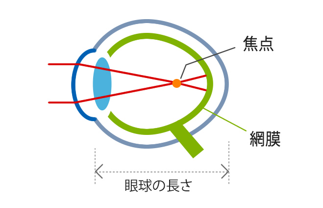 1.軸性近視