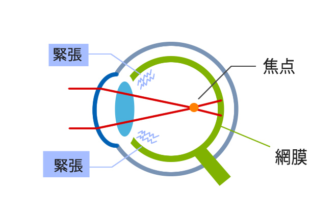 3.仮性近視