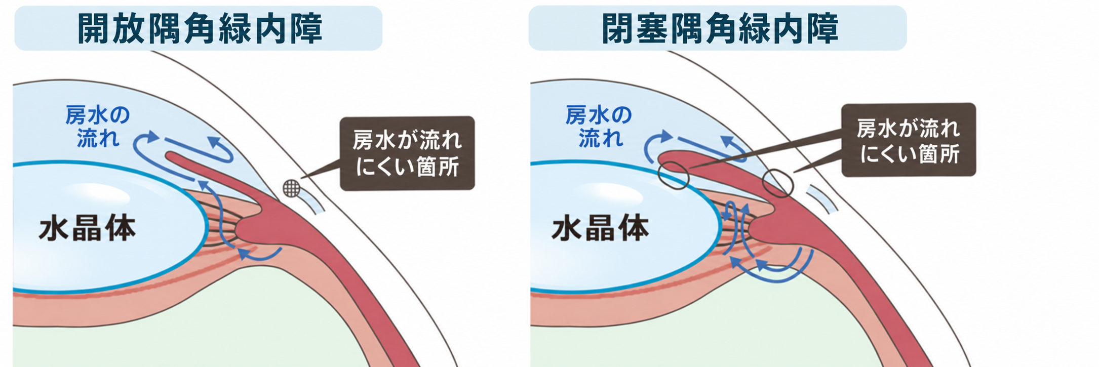 開放隅角緑内障と閉塞隅角緑内障における房水の流れと隅角の比較